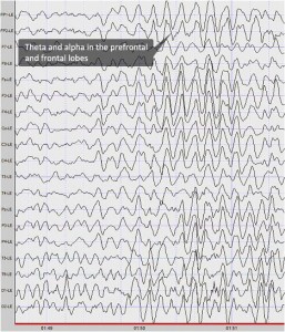 Graph of an ADHD Child's EEG