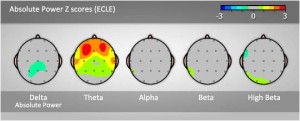 Z-Scores of an ADHD Child